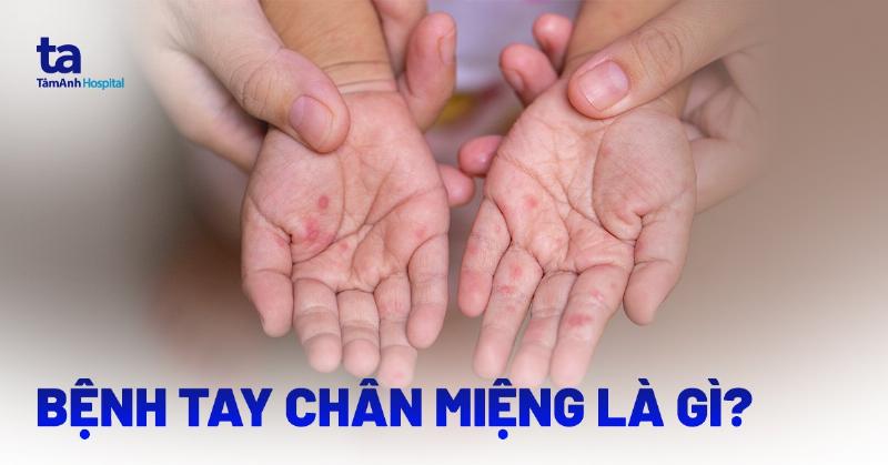 Mẹo hay từ các bác sĩ về chân tay miệng