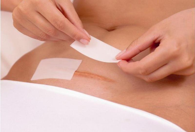 Chăm sóc vết mổ sau sinh mổ