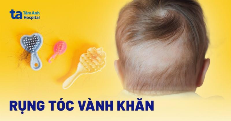 Các dấu hiệu thiếu vitamin D ở trẻ sơ sinh mẹ cần chú ý như rụng tóc vành khăn.