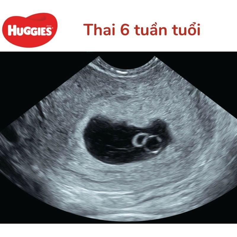 Hình ảnh minh họa túi thai con trai ở tuần thứ 6