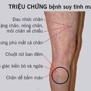 Kem Bôi Giãn Tĩnh Mạch Carusos Veins Care Cream 75Gr Của Úc