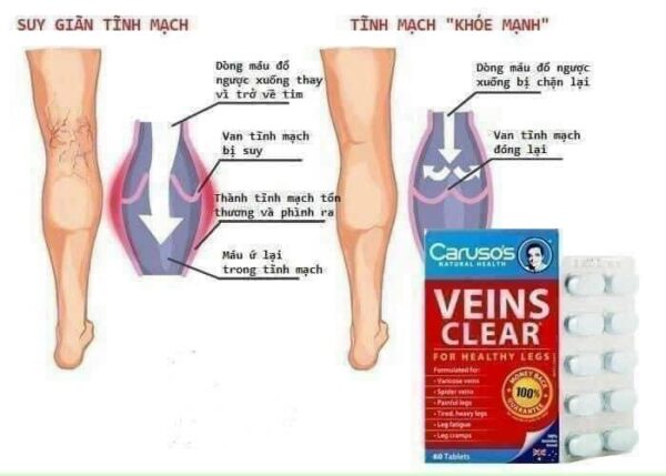 Kem Bôi Giãn Tĩnh Mạch Carusos Veins Care Cream 75Gr Của Úc