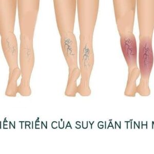 Kem Bôi Giãn Tĩnh Mạch Carusos Veins Care Cream 75Gr Của Úc