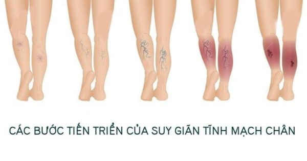 Kem Bôi Giãn Tĩnh Mạch Carusos Veins Care Cream 75Gr Của Úc